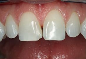 Morgan Family Dentistry | Dental Fillings, Dental Bridges and Veneers